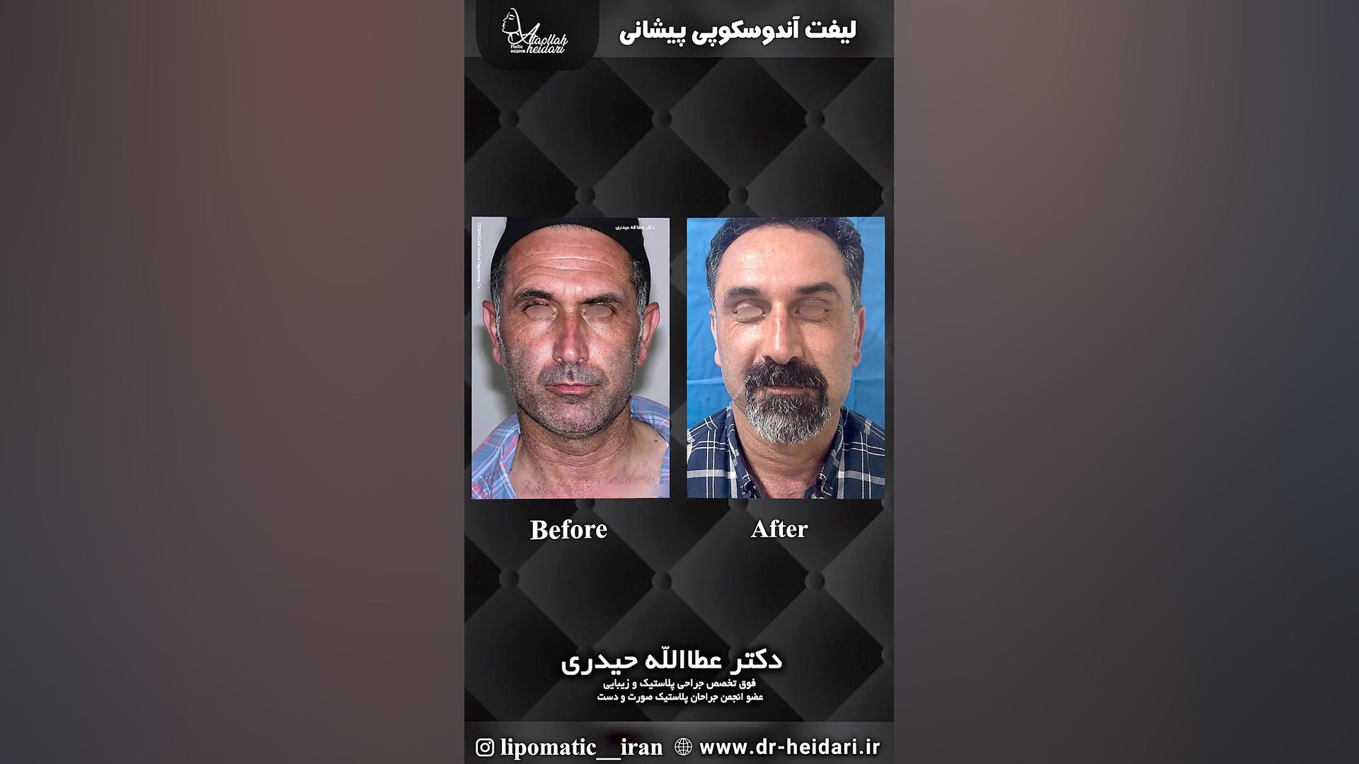 لیفت اندوسکوپی پیشانی CUT&Tag