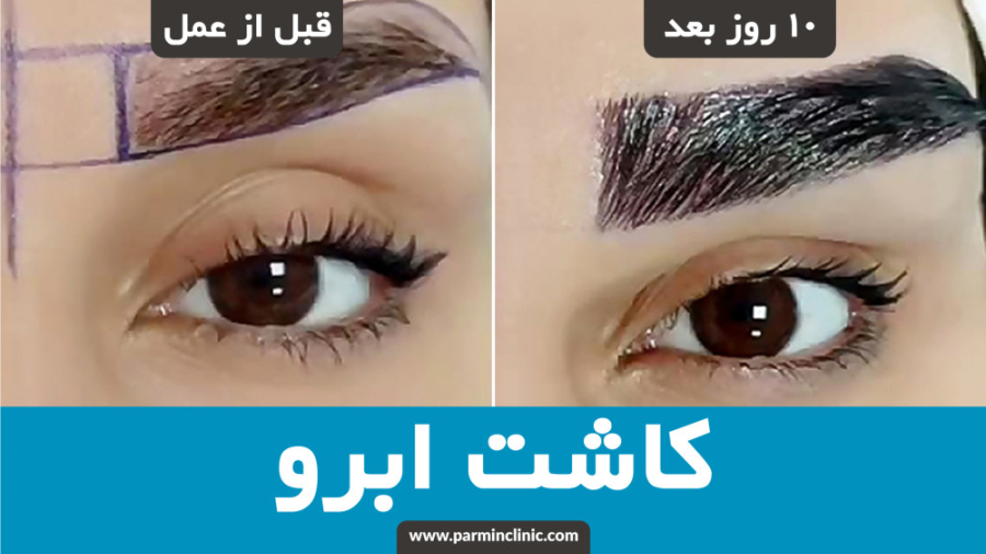 قبل و ده روز بعد از کاشت ابرو زیبا جوی عزیزمون در کلینیک زیبایی پارمین کاشت ریش