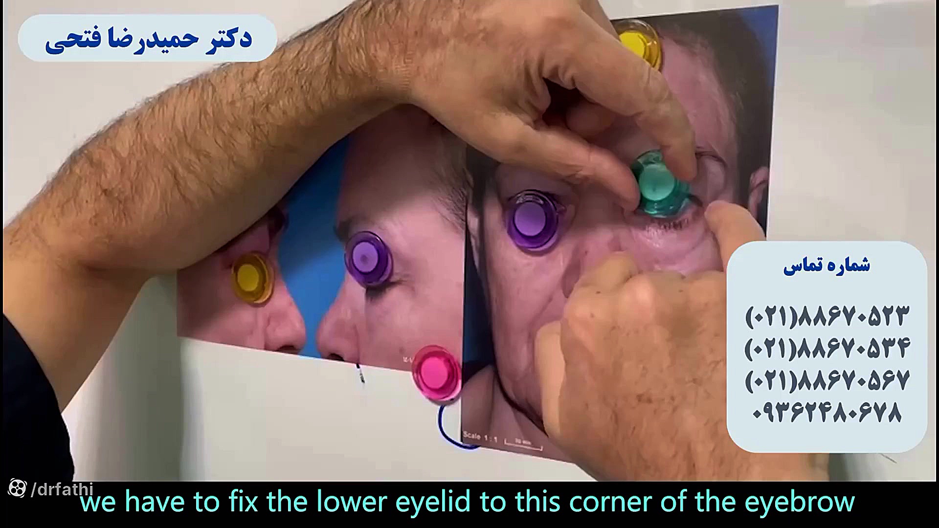 فیلم جراحی پلک افتاده دکتر حمید رضا فتحی فوق تخصص جراحی پلاستیک