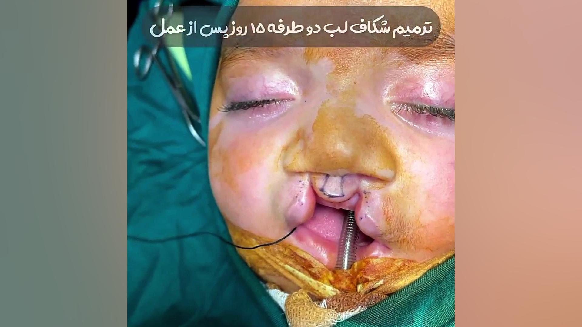 فیلم ترمیم شکاف کام لب دکتر حمید رضا فتحی فوق تخصص جراحی پلاستیک