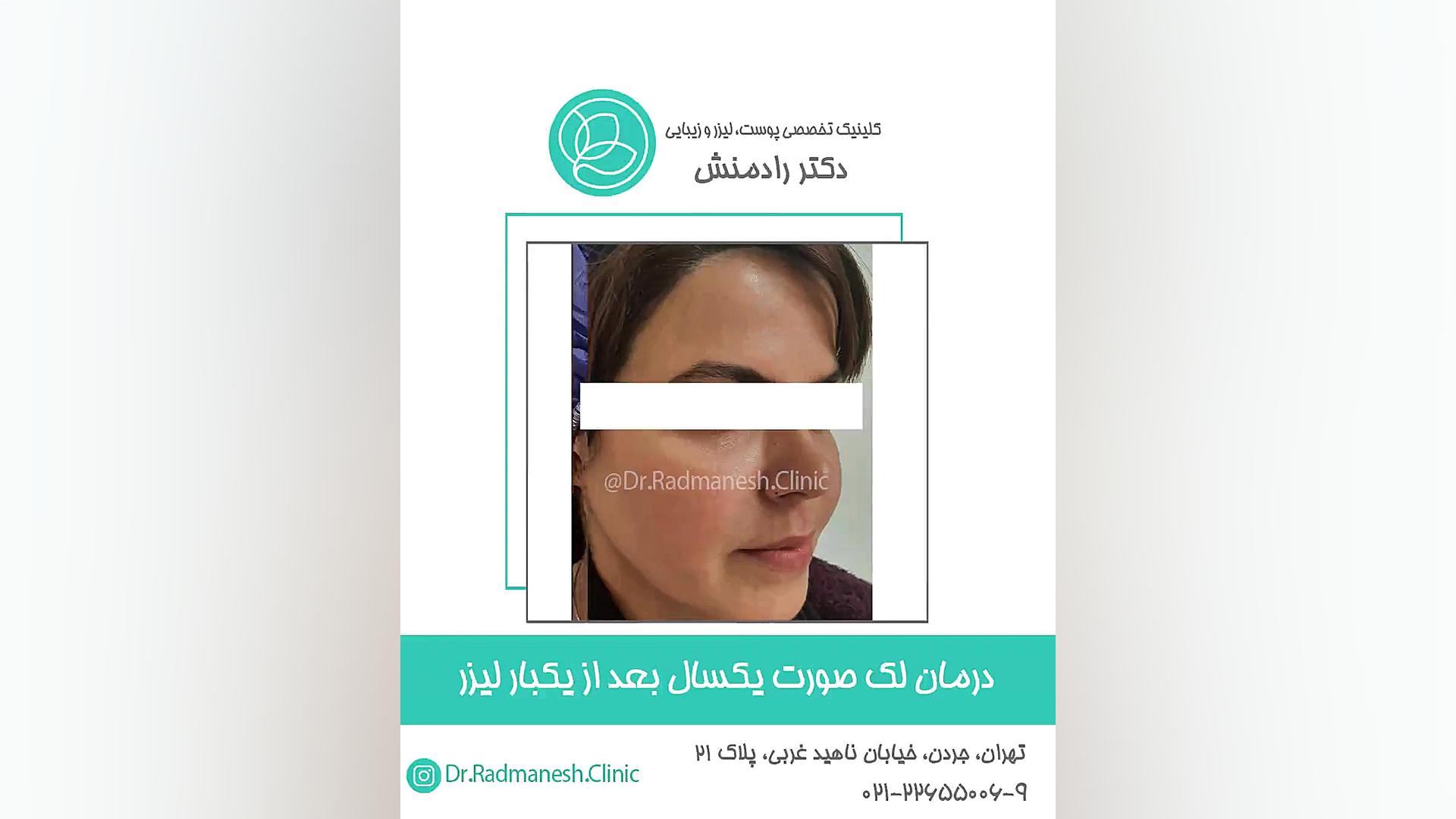 درمان لک صورت یکسال بعد از یک بار لیزر پوسیدگی دندان