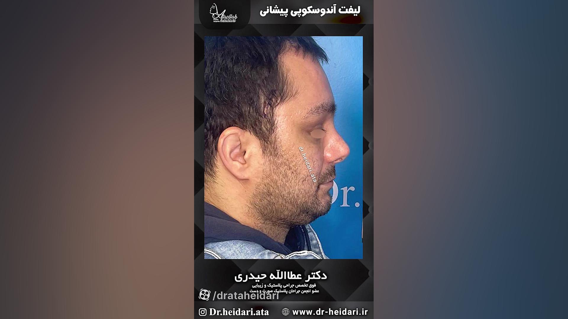 لیفت اندوسکوپی پیشانی V/Q Scan
