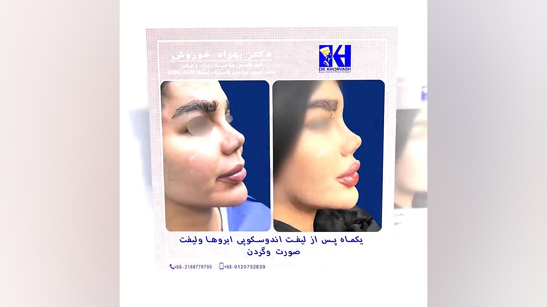 یکماه پس از لیفت آندوسکوپی ابروها و لیفت صورت و گردن Axon Guidance Study