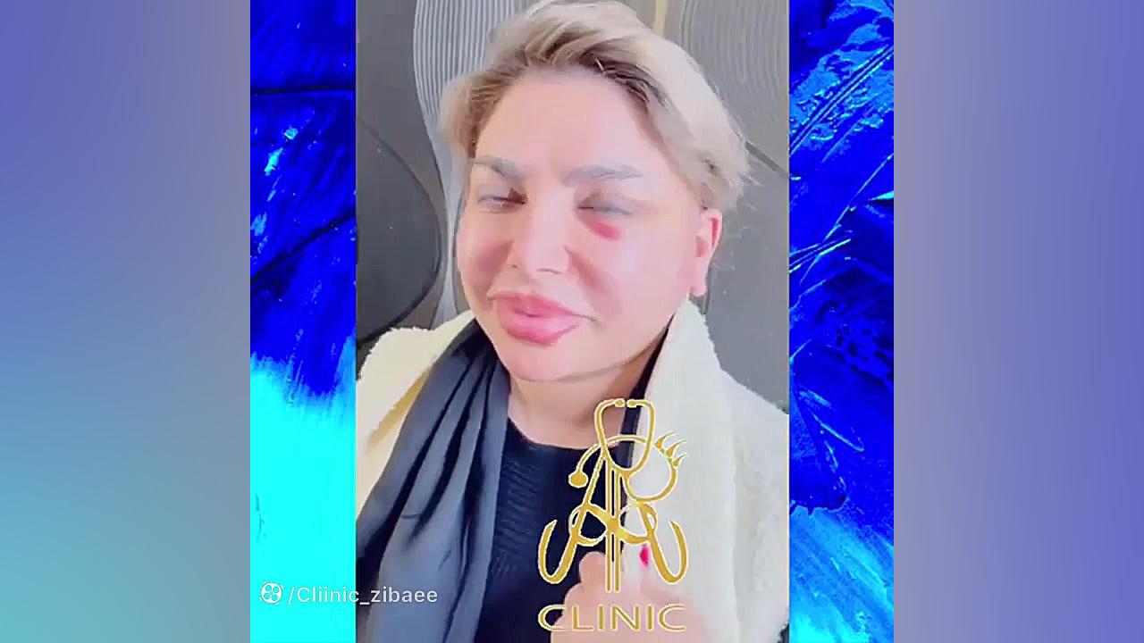 بلافاصله بعد از لیفت گونه و گردن تست مهارکننده کمپلیمانت