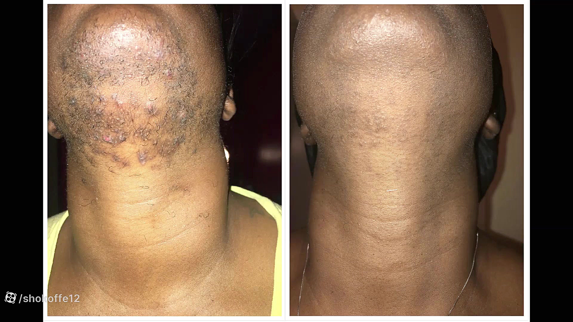 کلینیک تخصصی لیزر موهای زائد ان트ريكتینیب