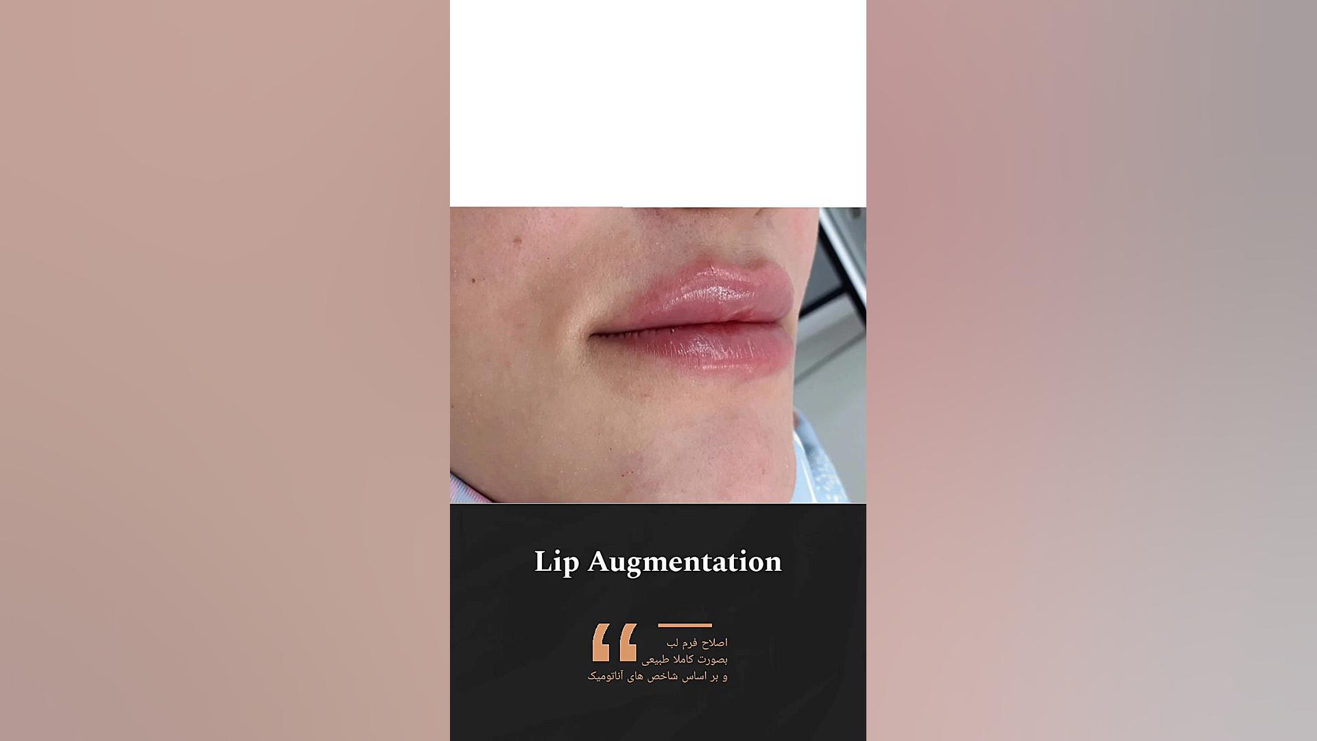 تزریق فیلر لب (دکتر مرضیه صحت پور)drmarziyesehatpour