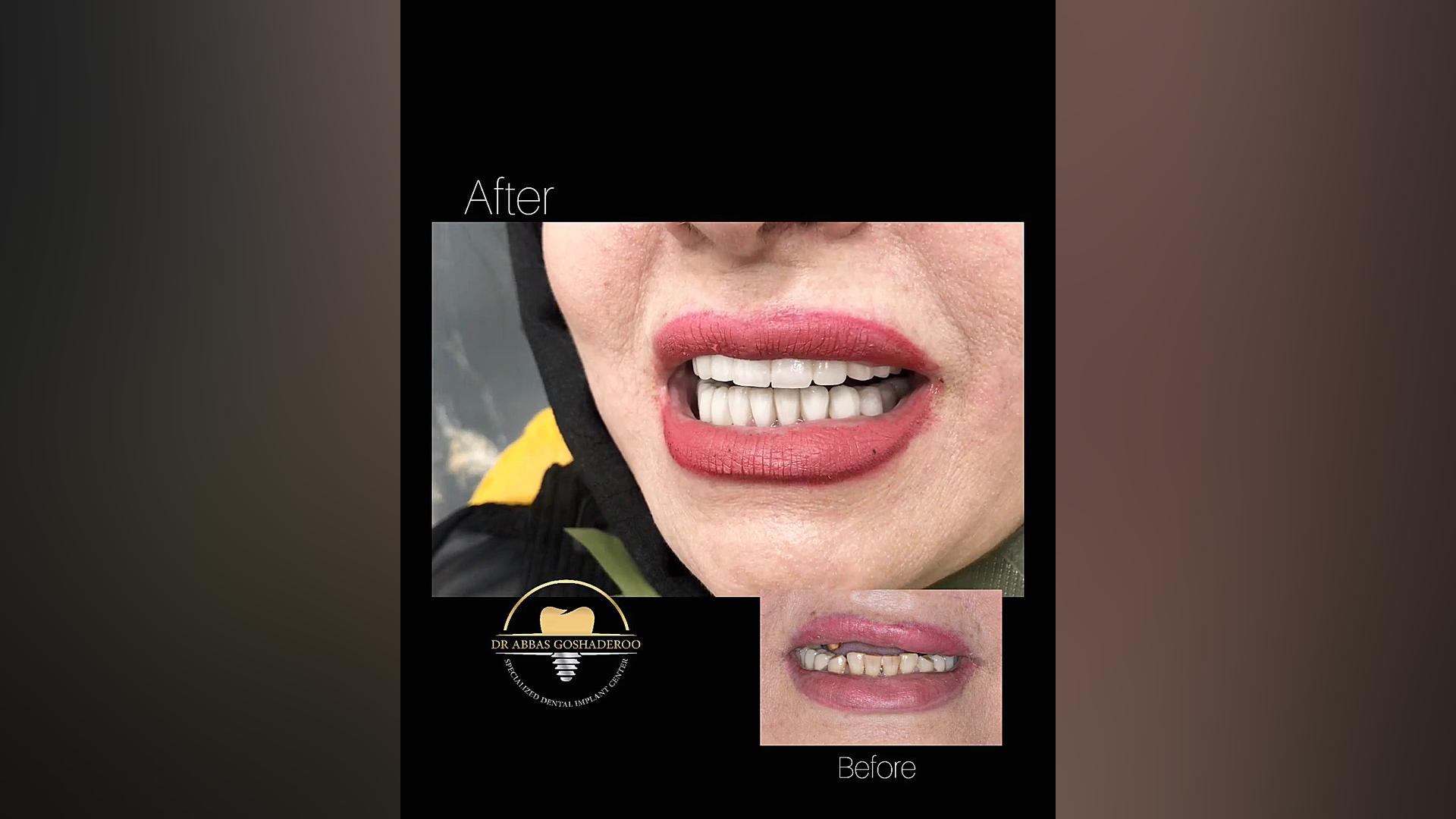 بازسازی دهان با ایمپلنت دکتر عباس گشاده رو، متخصص جراحی لثه و ایمپلنت