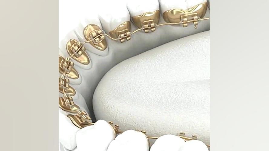 ارتودنسی دندان ها تسط بهترین دکتر ارتودنسی مشهد دکتر برهمن سبزواری - متخصص ارتودنسی - مشهد