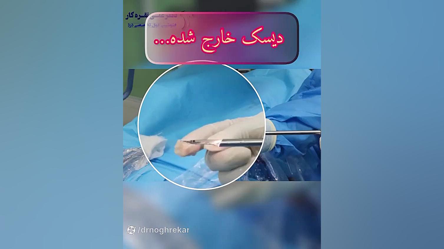 عمل بسته آندوسکوپی دیسک کمر ASO Test