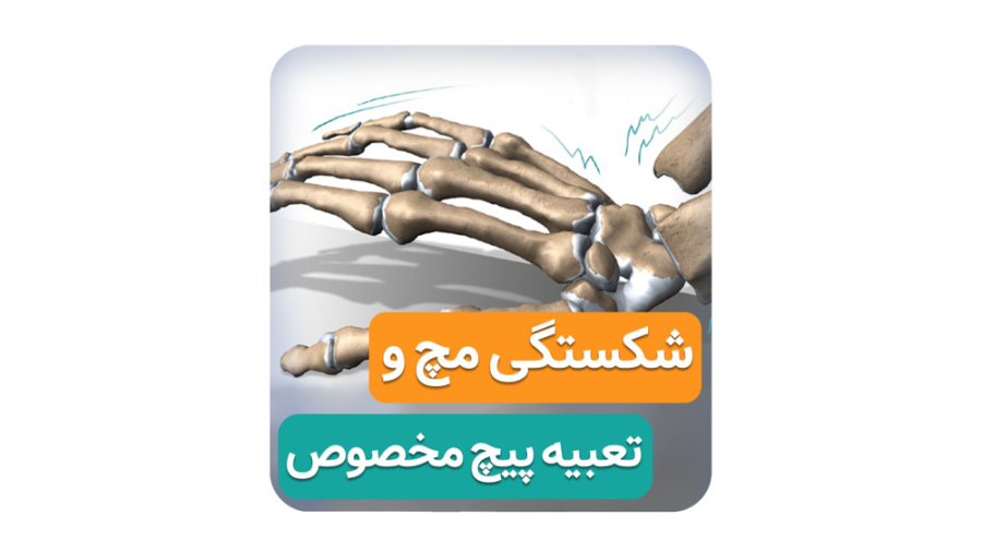 شکستگی مچ و تعبیه پیچ مخصوص ( دکتر محمدرضا صادقی _ جراح ارتوپد تهران ) چای خور چای