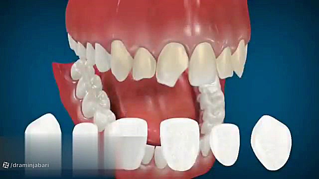 انیمیشن کامپوزیت دندان دکتر امین جباری