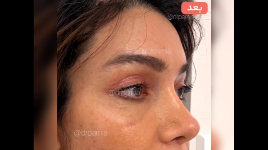 معجزه لیفت آندوسکوپیک ابرو و بلفاروپلاستی دکتر رفیع پرنیا فوق تخصص پلاستیک