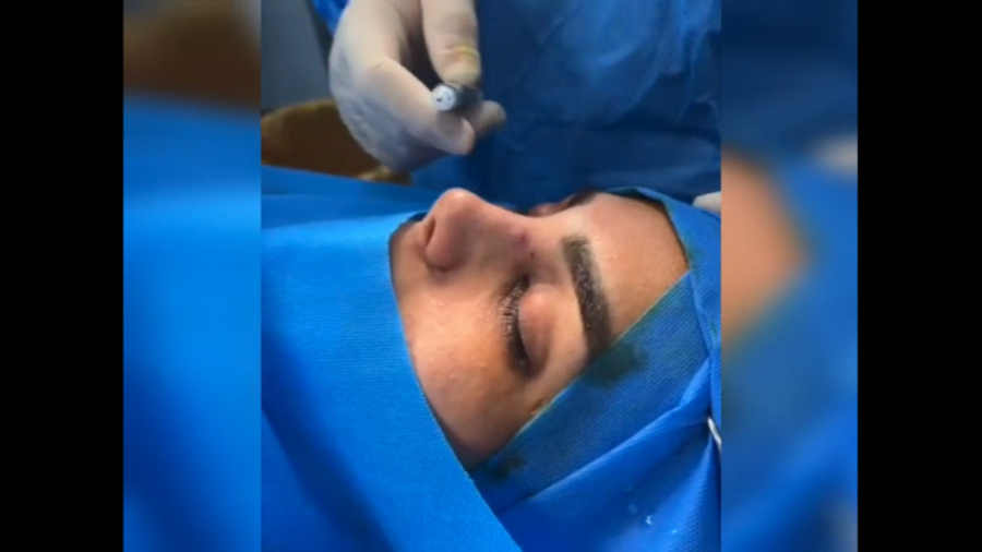 جراحی زیبایی بینی با روش بسته دکتر رفیع پرنیا فوق تخصص پلاستیک