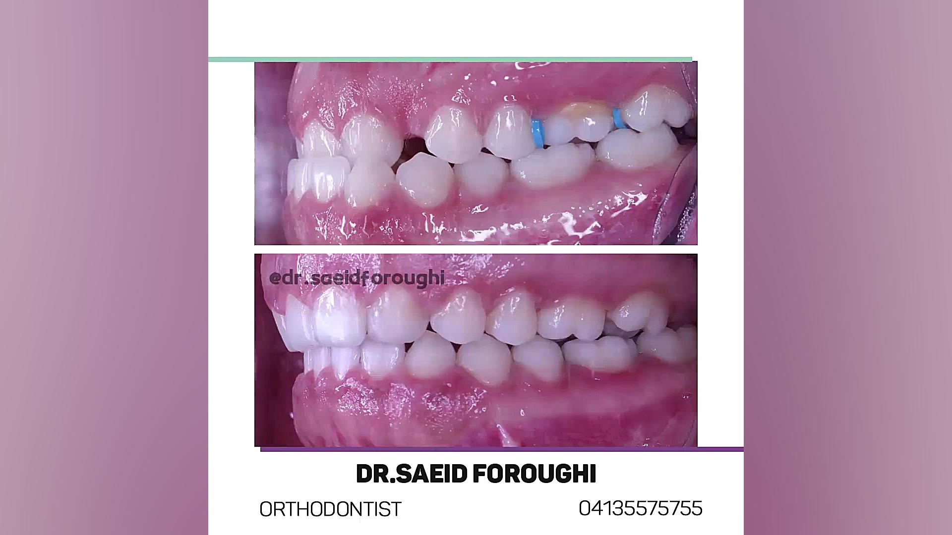 . درمان ترکیبی ارتودنسی و جراحی فک دکتر سعید فروغی متخصص ارتودنسی