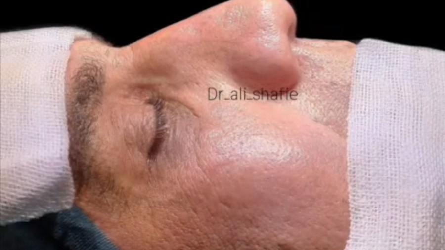 نتیجه جراحی بینی گوشتی در سنین بالا دکتر علی شفیعی رونیزی | بهترین جراح بینی تهران