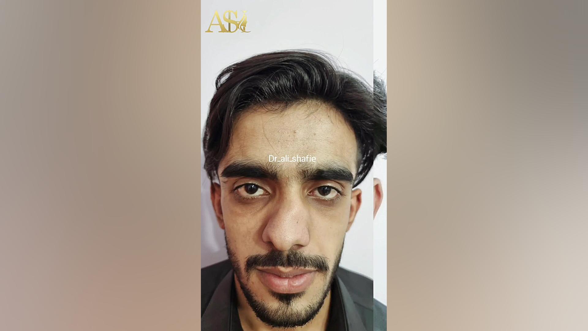 جراحی بینی گوشتی با کجی شدید دکتر علی شفیعی رونیزی | بهترین جراح بینی تهران