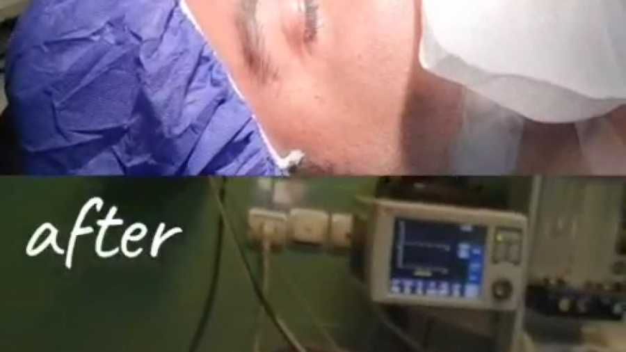 بلافاصله بعد از عمل بینی دکتر علی شفیعی رونیزی | بهترین جراح بینی تهران