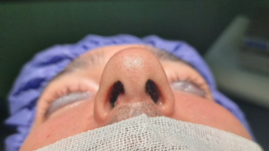 نتیجه عمل بینی بعد از چند ماه دکتر علی شفیعی رونیزی | بهترین جراح بینی تهران