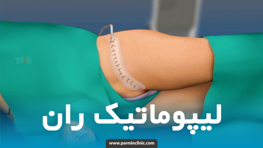 انیمیشن لیپوماتیک ران رزولین