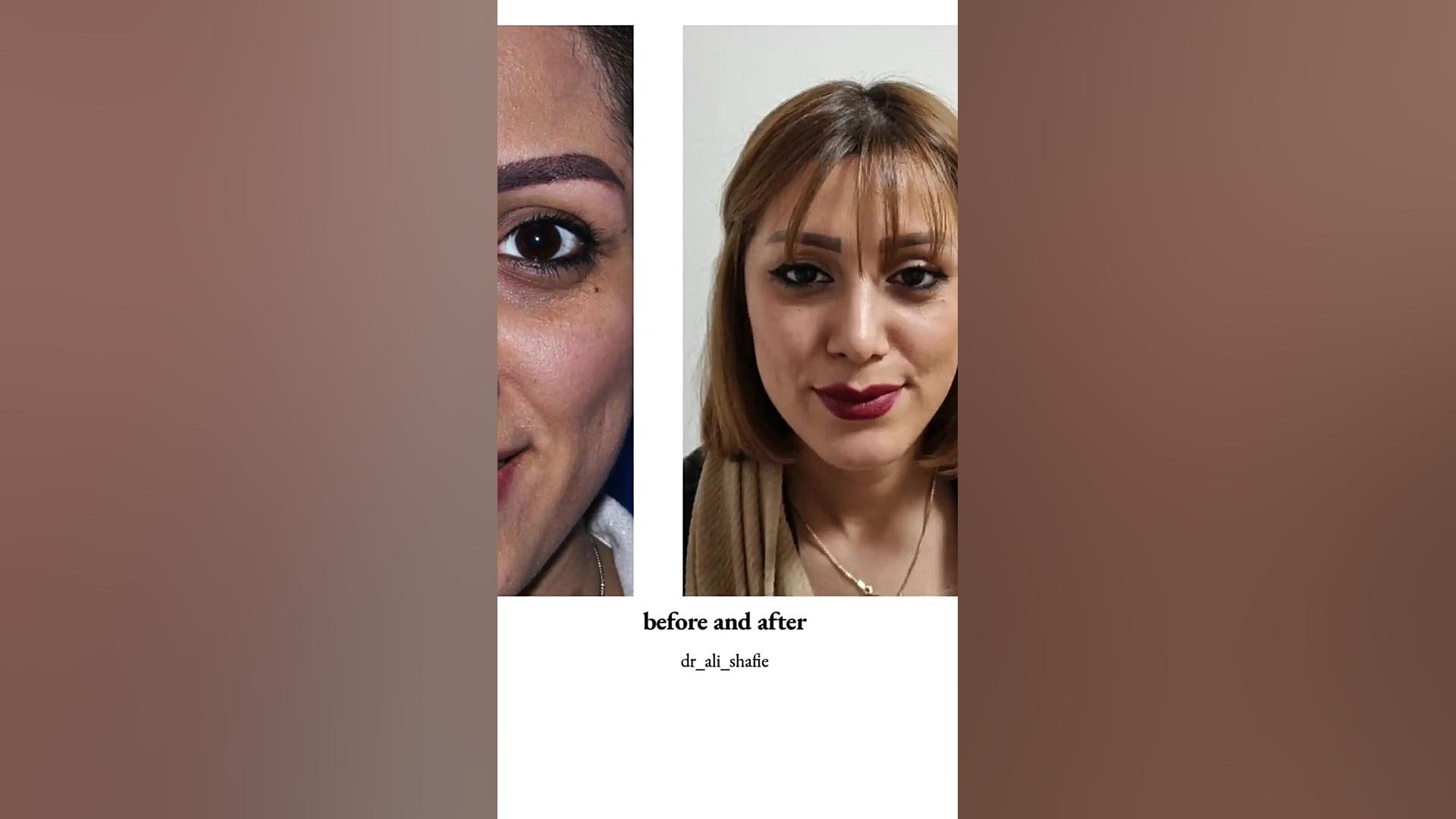 جراحی بینی استخوانی همراه با تغییرات مثبت فراوان دکتر علی شفیعی رونیزی | بهترین جراح بینی تهران
