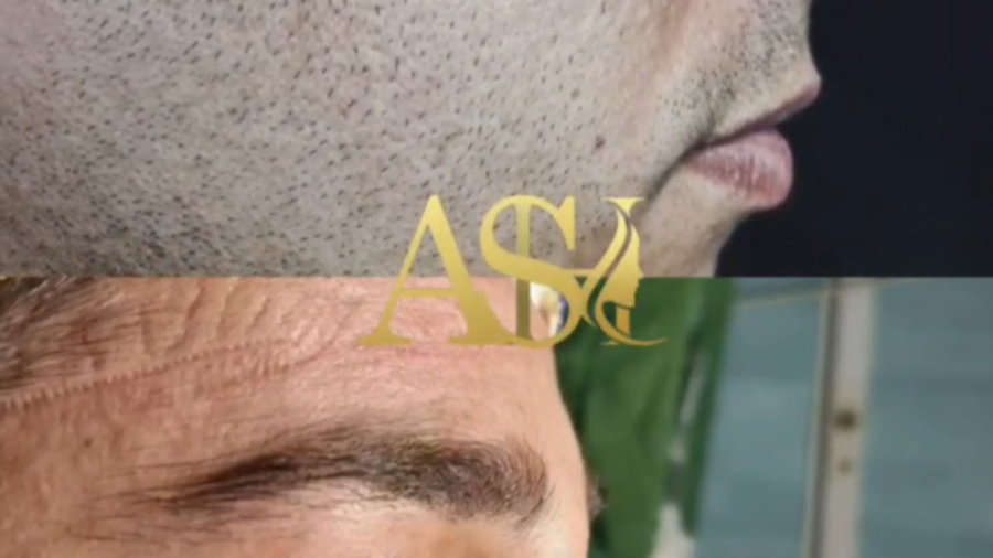 بلافاصله بعد از عمل بینی دکتر علی شفیعی رونیزی | بهترین جراح بینی تهران