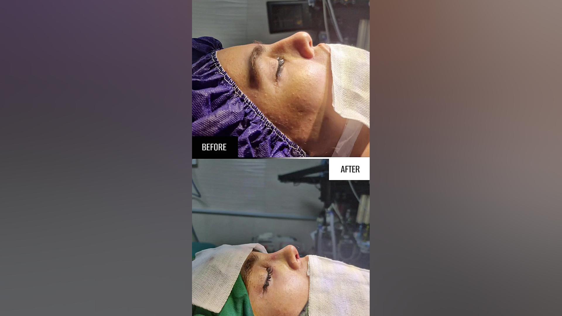 عمل بینی نیمه فانتزی دکتر علی شفیعی رونیزی | بهترین جراح بینی تهران