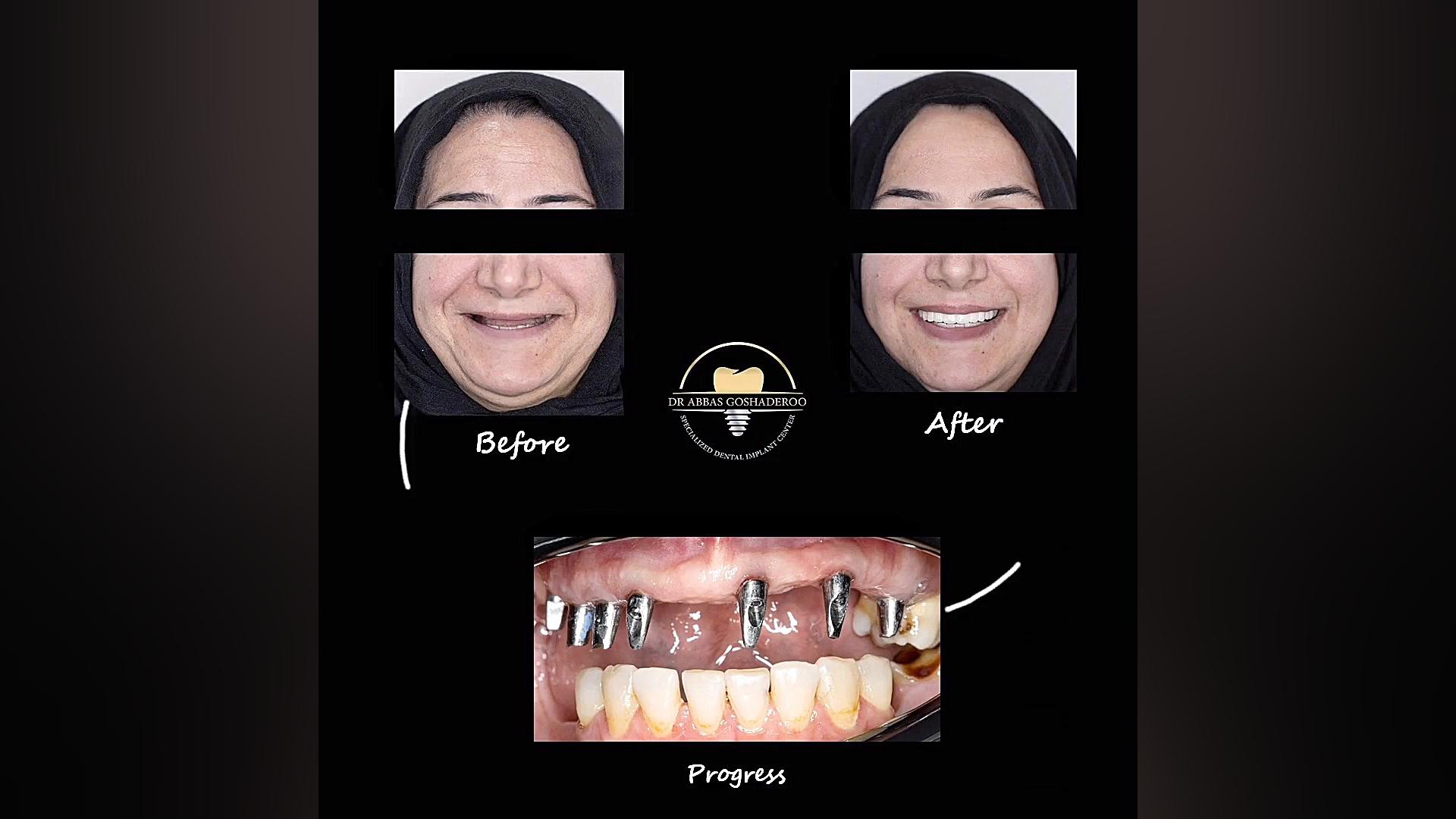 با ما با اعتماد به نفس می خندید دکتر عباس گشاده رو، متخصص جراحی لثه و ایمپلنت