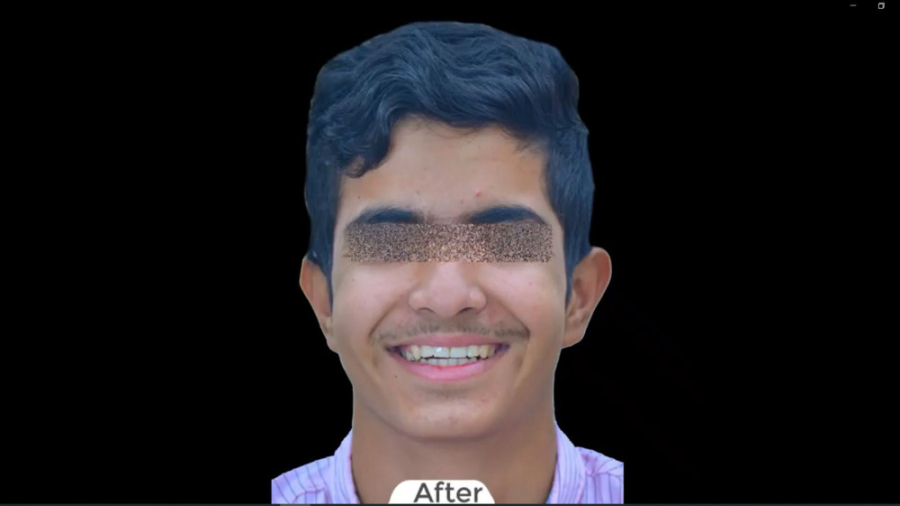 درمان ارتودنسی ثابت دو فک با کشیدن 2 دندان آسیای کوچک فک بالا برای پسر جوان دکتر برهمن سبزواری - متخصص ارتودنسی - مشهد