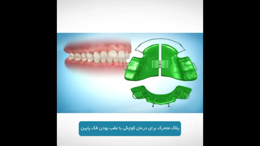 پلاک متحرک برای درمان کوچکی یا عقب بودن فک پایین دکتر برهمن سبزواری - متخصص ارتودنسی - مشهد