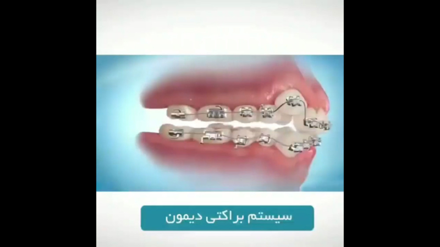 ادامه معرفی سیستم براکتی دیمون (Damon) دکتر برهمن سبزواری - متخصص ارتودنسی - مشهد