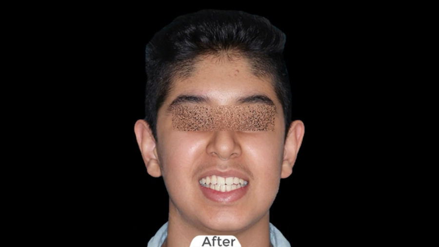 درمان ارتودنسی ثابت دو فک بدون کشیدن دندان در مدت 1.5 سال برای پسر نوجوان دکتر برهمن سبزواری - متخصص ارتودنسی - مشهد