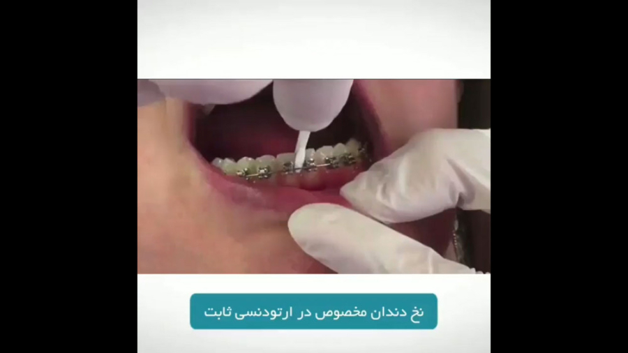نخ دندان مخصوص درمان ارتودنسی ثابت دکتر برهمن سبزواری - متخصص ارتودنسی - مشهد