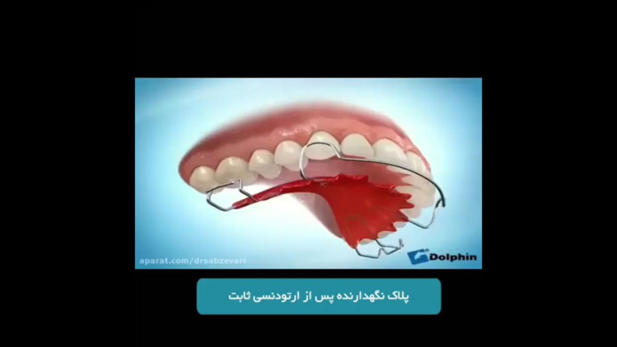 پلاک نگهدارنده پس از ارتودنسی ثابت دکتر برهمن سبزواری - متخصص ارتودنسی - مشهد