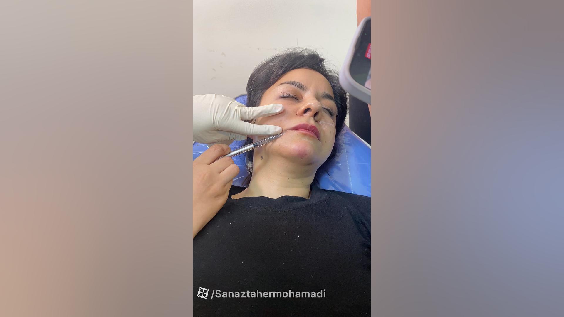 اموزش تزریق ژل(فیلر) به خط حزن یا ماریونت دستگاه لیزر پالس فمتوثانیه