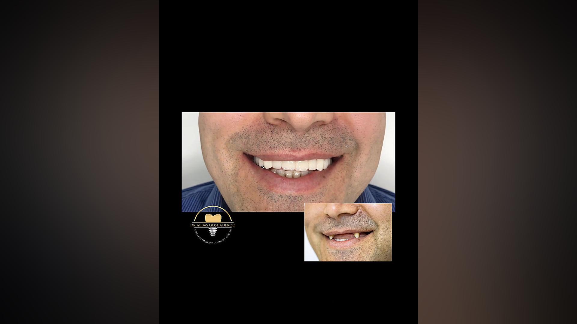 لبخندی دیگر دکتر عباس گشاده رو، متخصص جراحی لثه و ایمپلنت