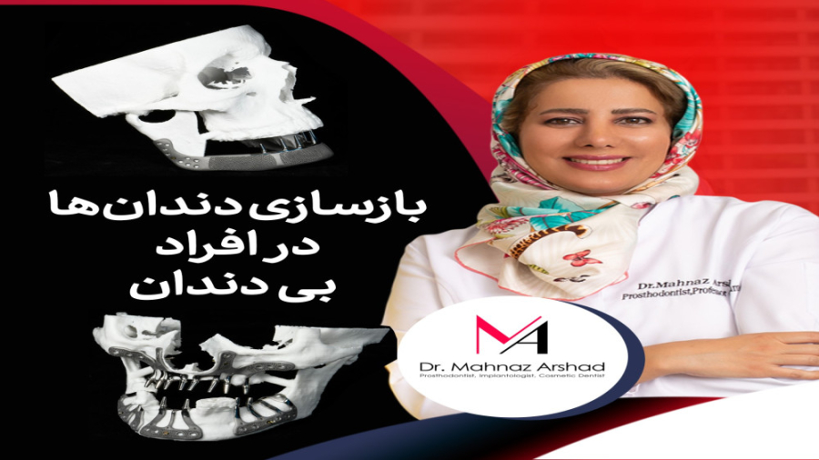 بازسازی دندانها در افراد بی دندان با تحلیل شدید استخوان دکتر مهناز ارشد