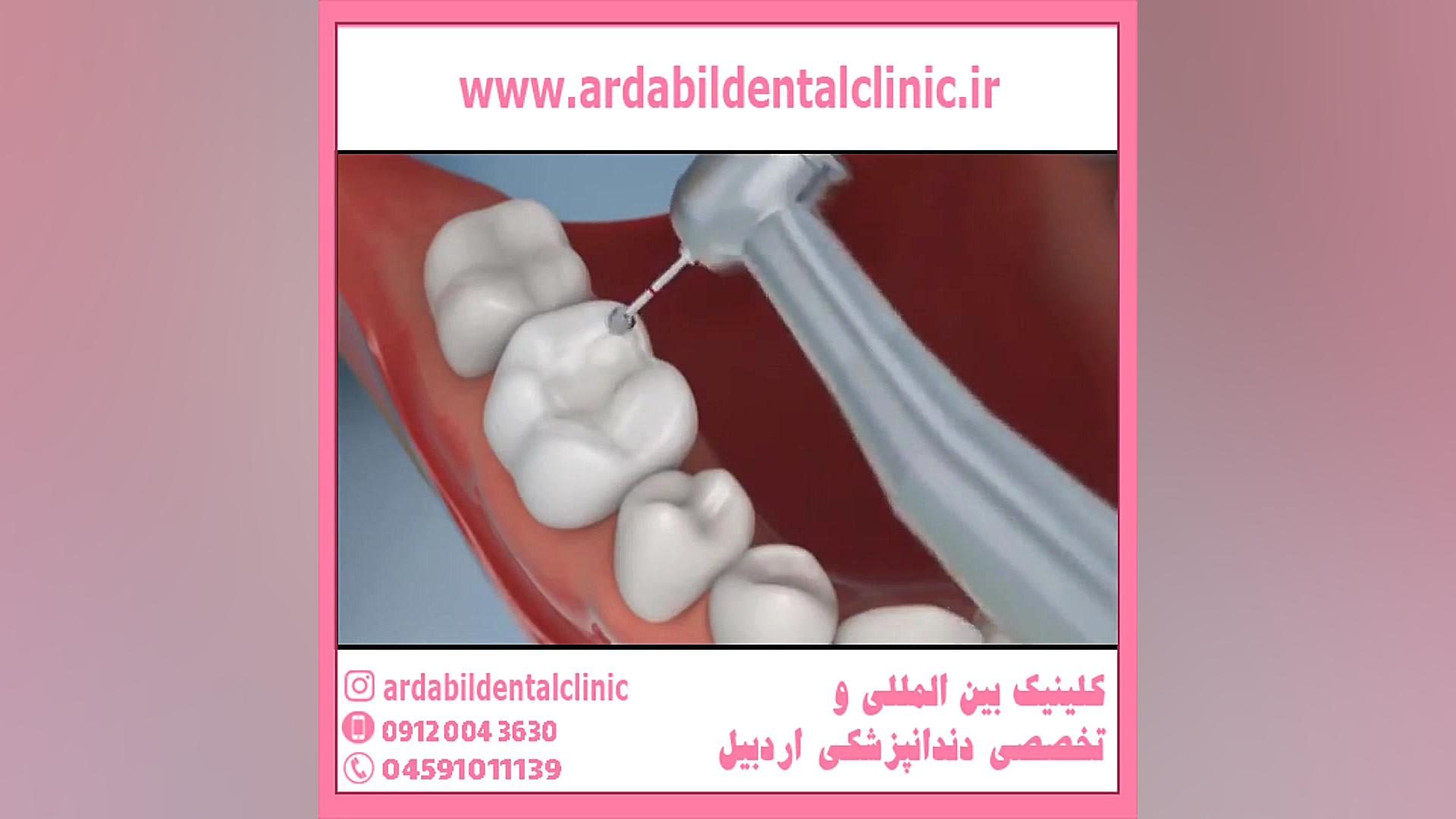 مراحل پر کردن دندان ها صفر تا صد مایکروگناتیا