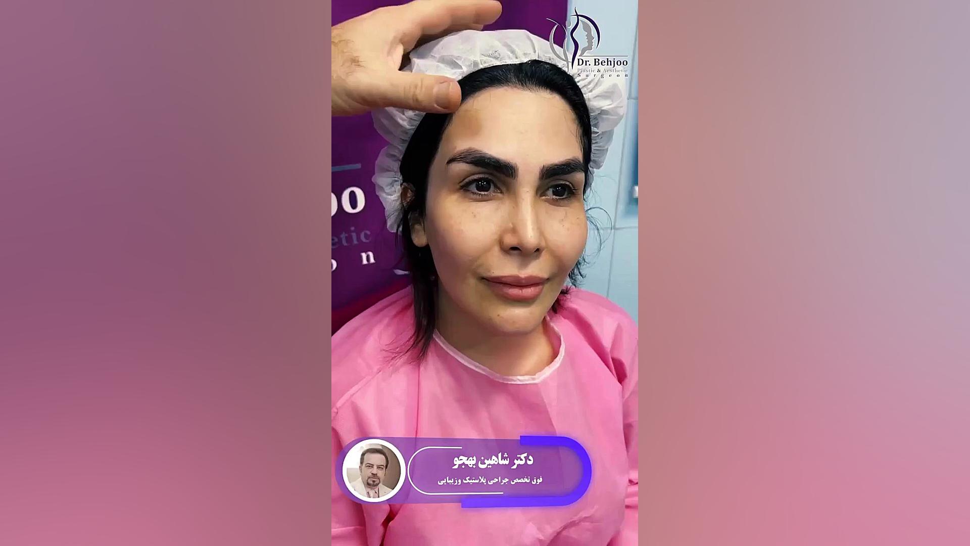 لیفت اندوسکوپی و تراش استخوان و سانترال لب دکتر شاهین بهجو - فوق تخصص جراحی پلاستیک