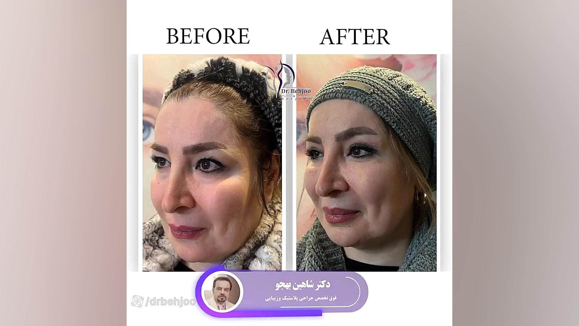 یک هفته بعد از بلفاروپلاستی پلک بالا دکتر شاهین بهجو - فوق تخصص جراحی پلاستیک