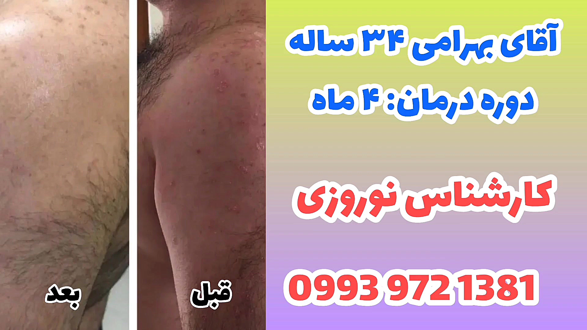 درمان ریشه ای پسوریازیس لیفت پیشانی