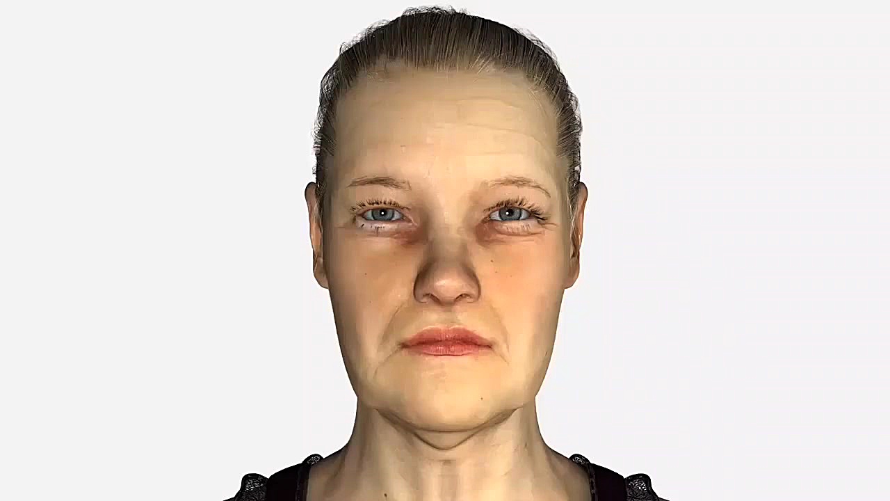 در جراحی لیفت صورت و گردن کدام اجزای صورت کشیده می شوند؟ کلینیک دکتر مهدی شیری