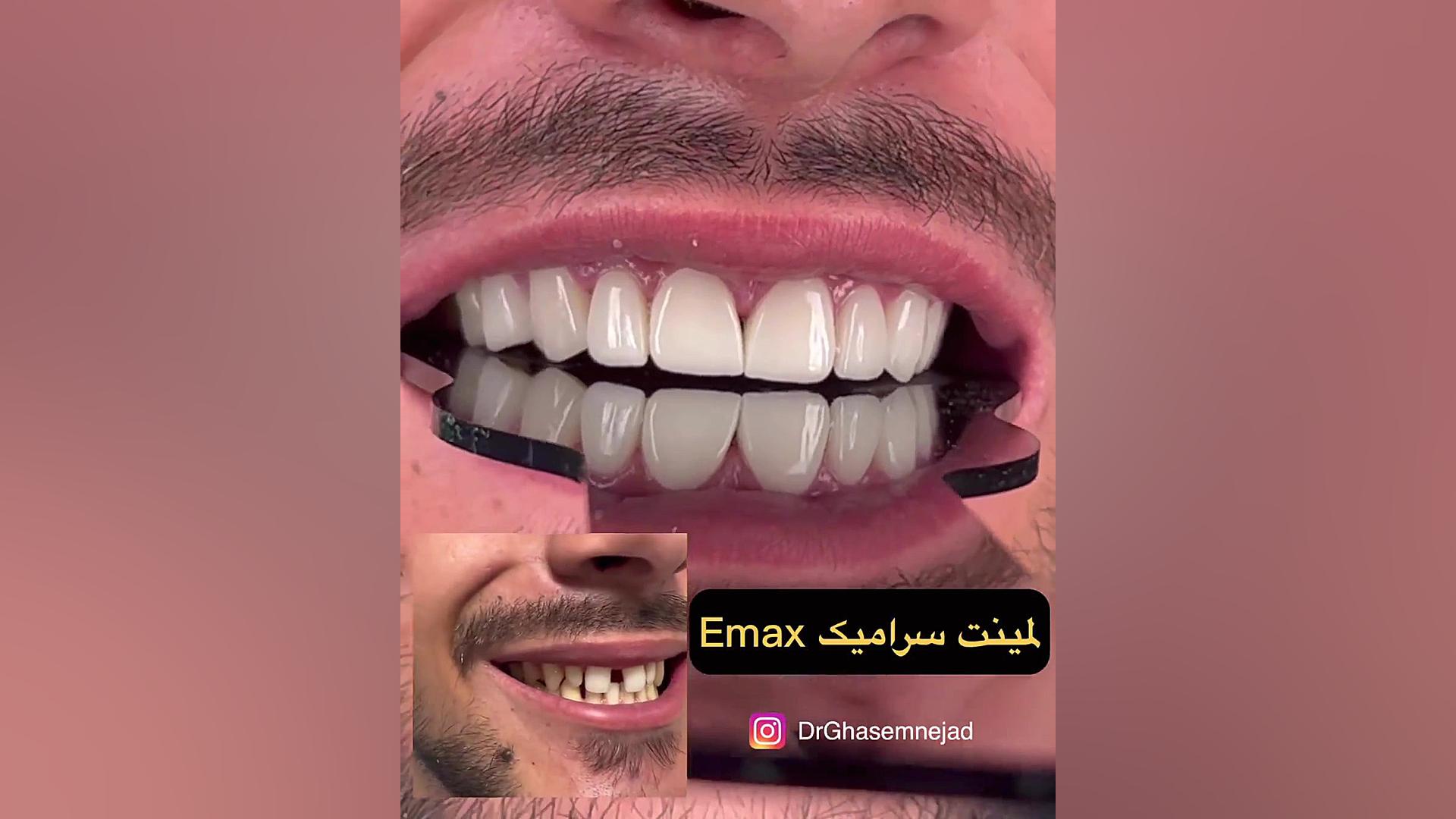قیمت لمینت دندان دندانپزشکی زیبایی دکتر قاسم نژاد