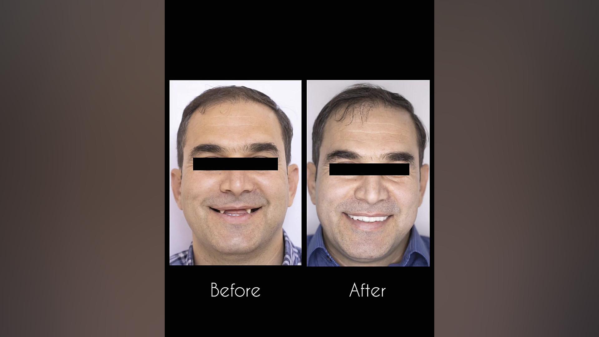 بهره گیری از ایمپلنت دندان برای خلق لبخندی متفاوت دکتر عباس گشاده رو، متخصص جراحی لثه و ایمپلنت