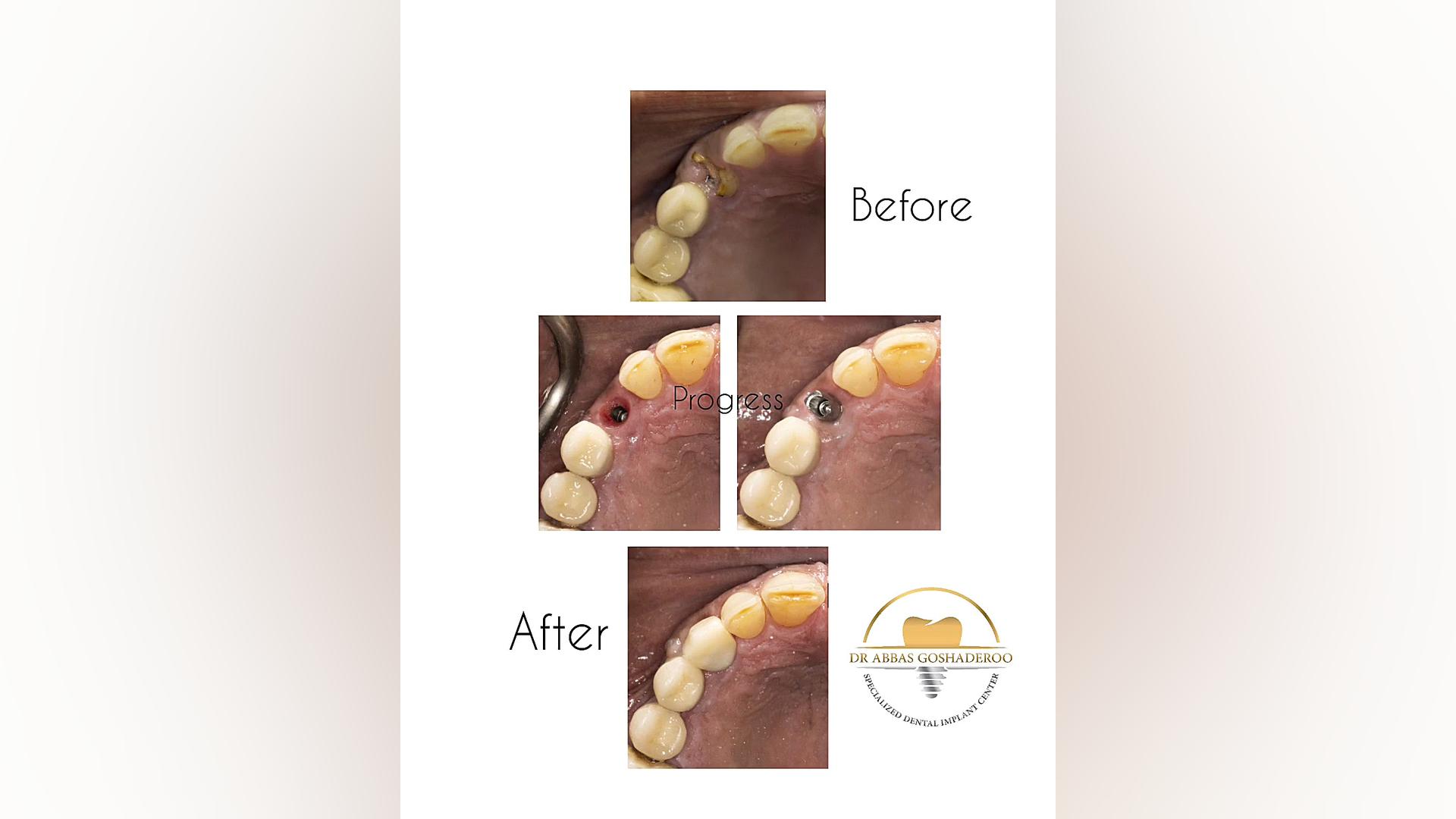 اصلاح طرح لبخند با ایمپلنت دندان دکتر عباس گشاده رو، متخصص جراحی لثه و ایمپلنت