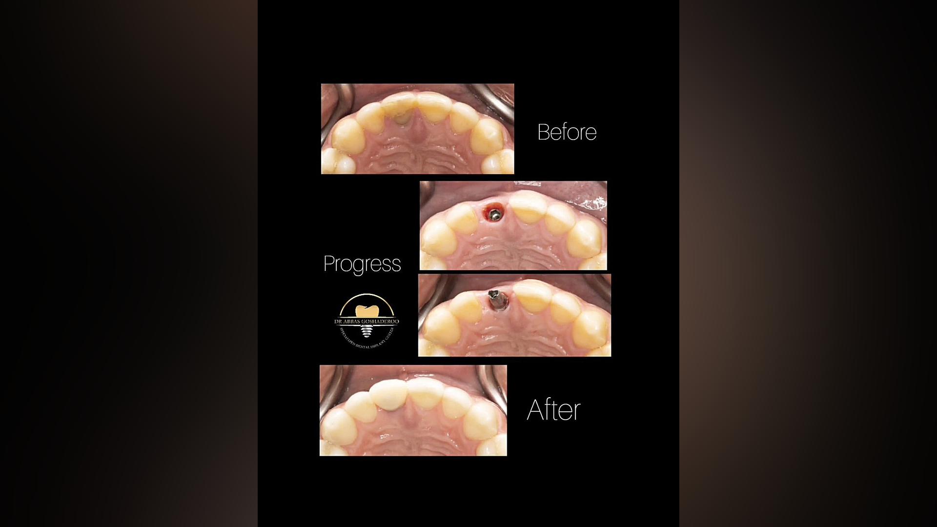 خلق یک لبخند متفاوت دیگر در کلینیک دکتر عباس گشاده رو دکتر عباس گشاده رو، متخصص جراحی لثه و ایمپلنت