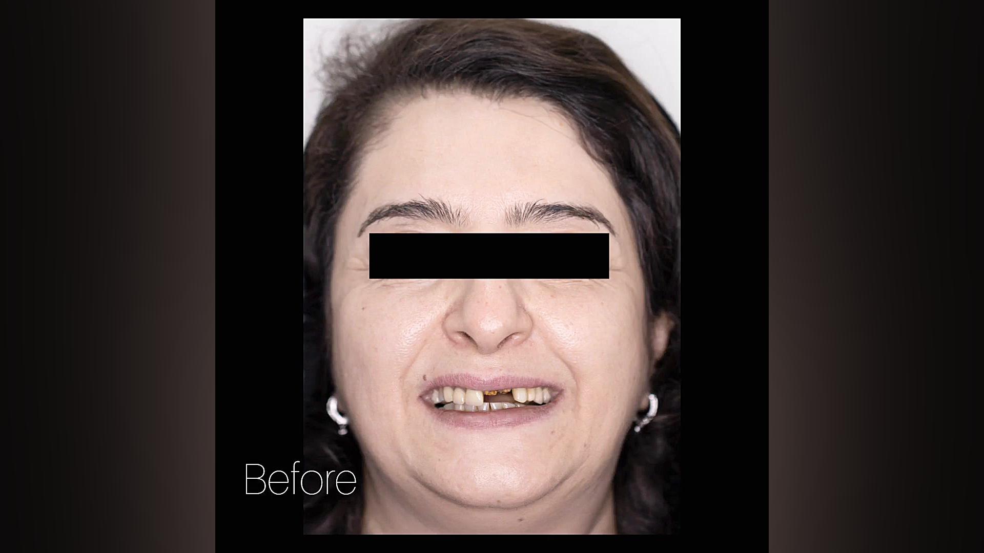 ترکیب ایمپلنت و لمینت دندان و هدیه کردن لبخند زیبا به مراجعه کننده عزیزمون دکتر عباس گشاده رو، متخصص جراحی لثه و ایمپلنت