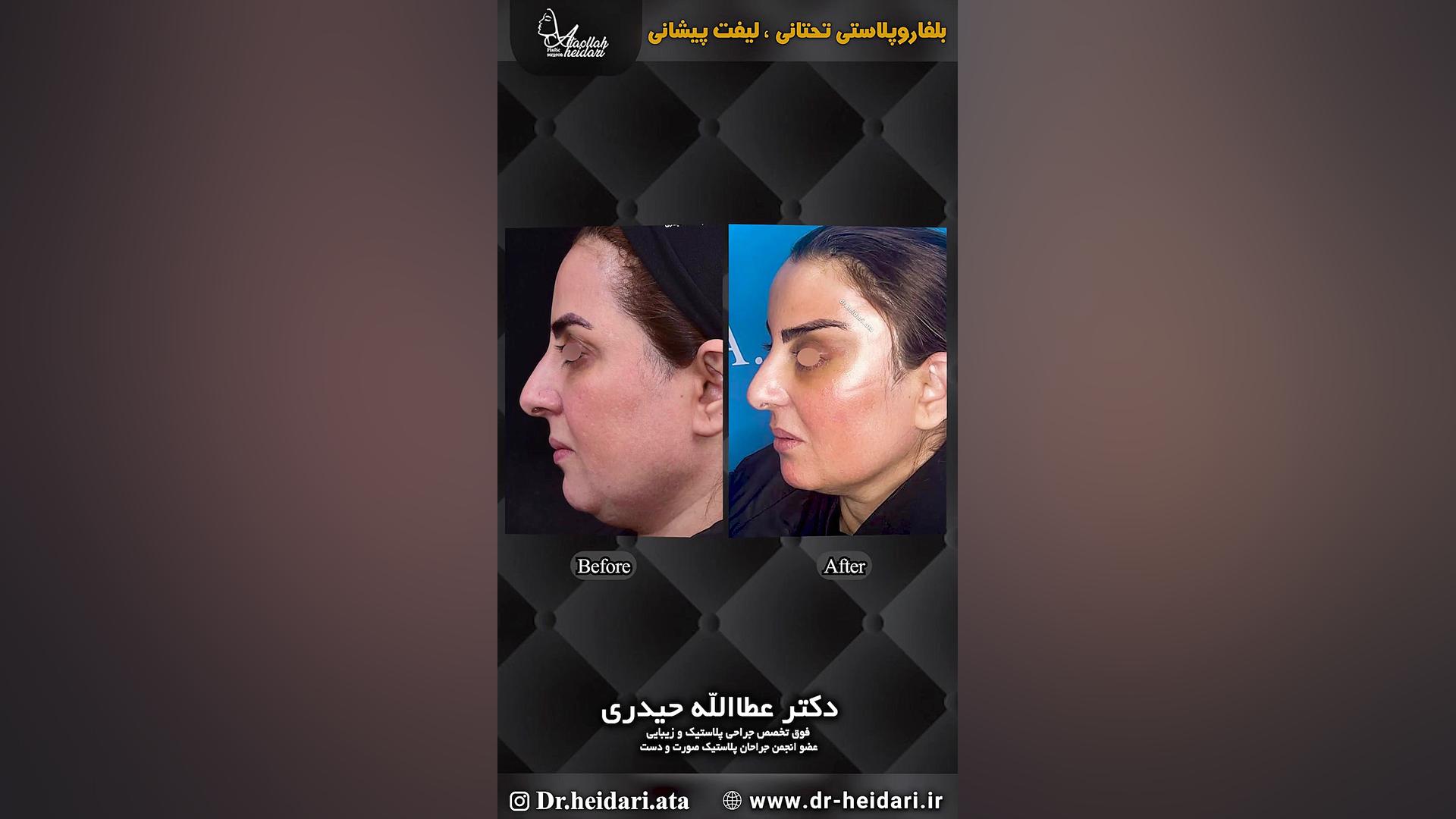 بلفاروپلاستی تحتانی و لیفت پیشانی آزمون آلدوستِرون پلاسما
