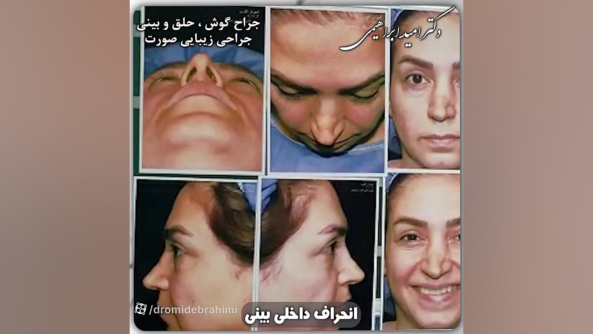 جراحی بینی ترمیمی توسط دکتر امید ابراهیمی بهترین جراح ترمیم بینی در تهران دکتر امید ابراهیمی