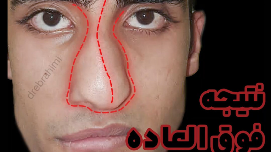 نتیجه جراحی بینی با انحراف زیاد توسط دکتر امید ابراهیمی دکتر امید ابراهیمی