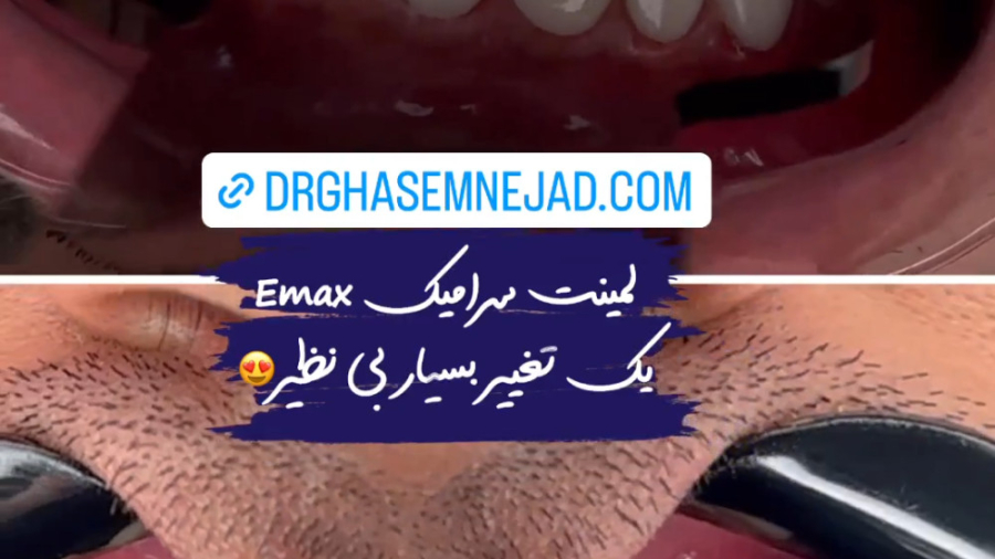 قیمت لمینت ایمکس دندانپزشکی زیبایی دکتر قاسم نژاد